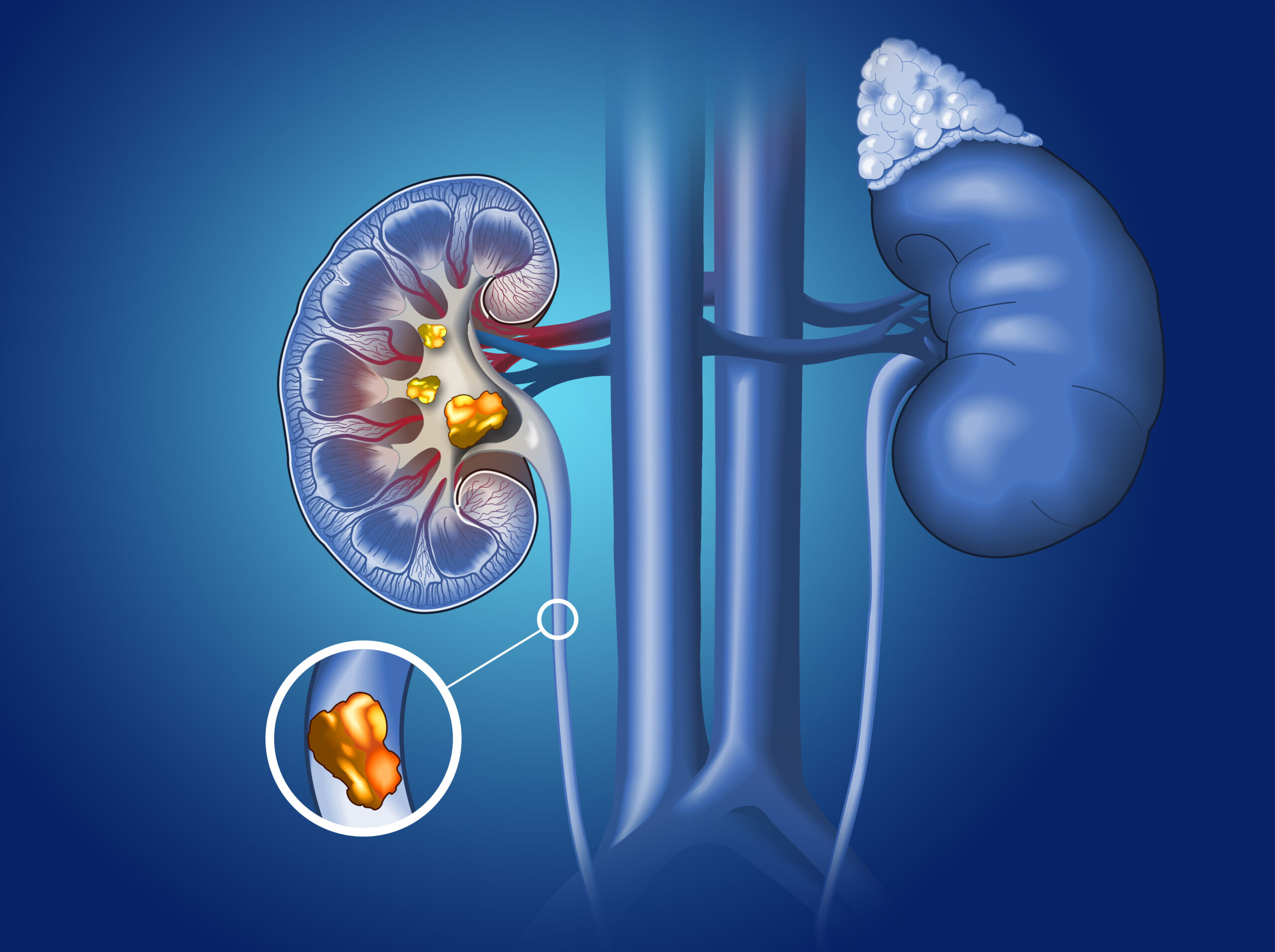 Kidney stones in kidney and ureter, medically illustration